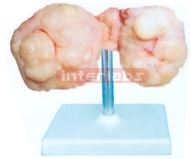 HUMAN MODEL OF THE PROSTATE GLAND INCREASES